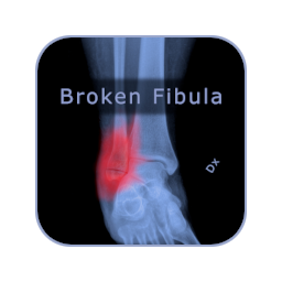 Broken Fibula logo